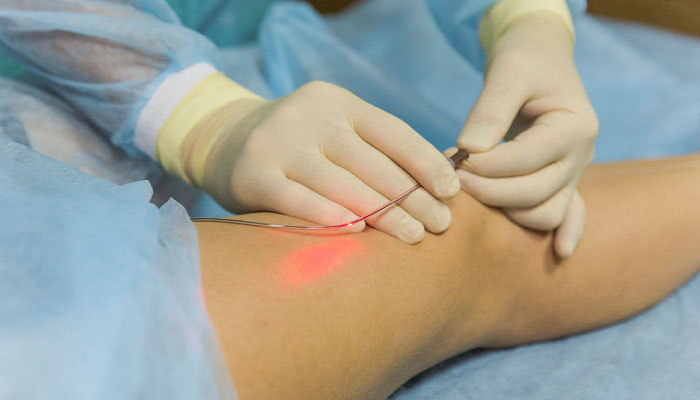 Endovenous Laser Treatment (EVLT)