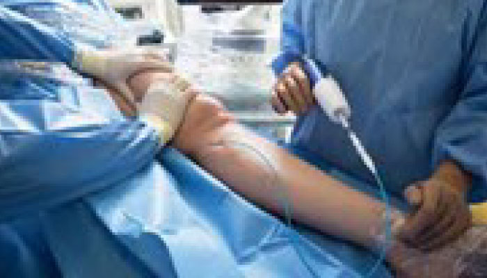 Glue Treatment for Varicose Veins (Venaseal)