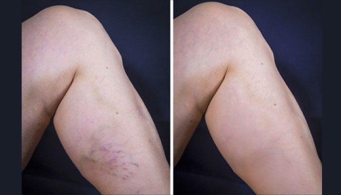 Sclerotherapy for Varicose Veins & Spider Veins